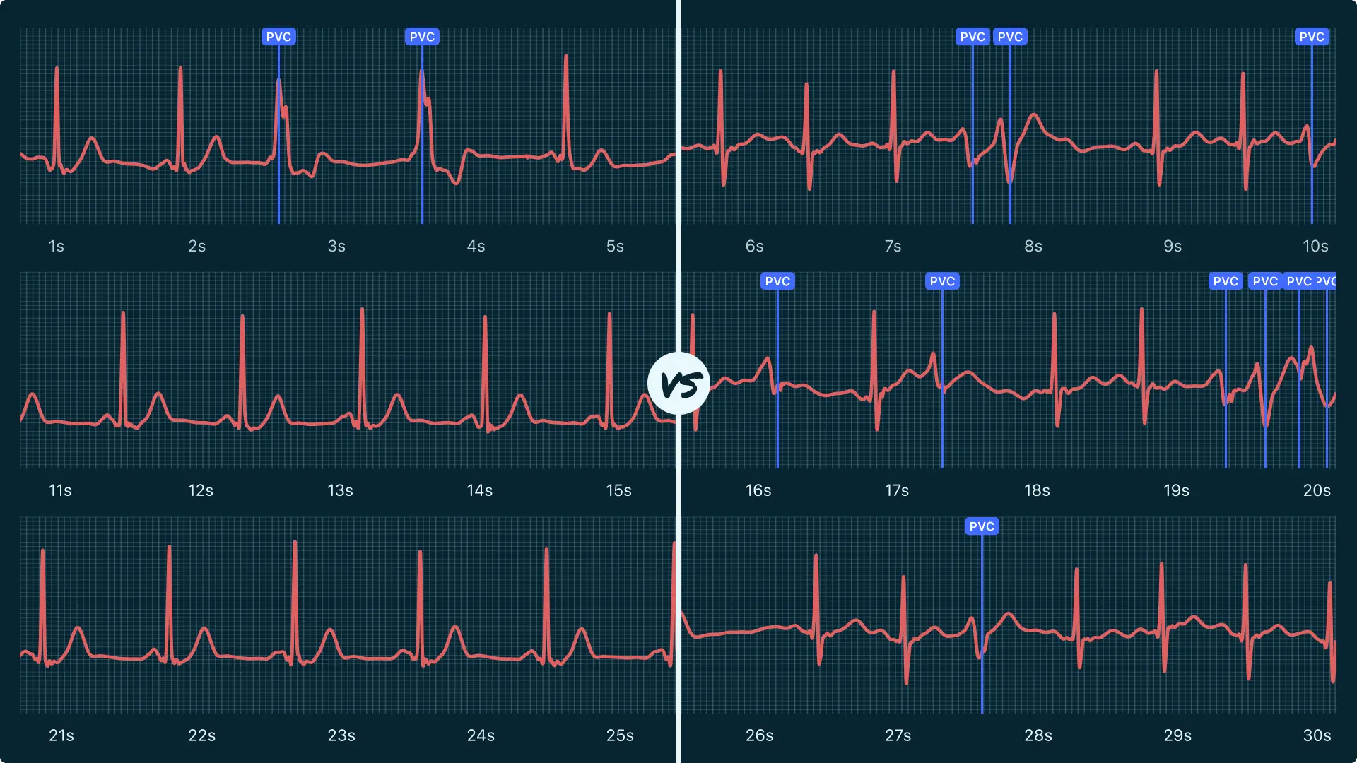 Premature Ventricular Contraction (Couplet) Vs. Ventricular Tachycardia